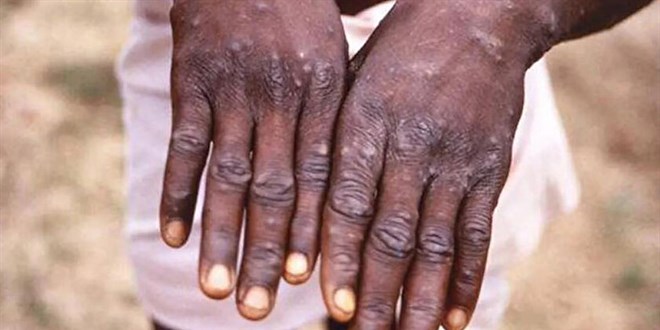 Avrupa'da yeni virüs alarmı: İngiltere'de vaka sayısı dokuza yükseldi