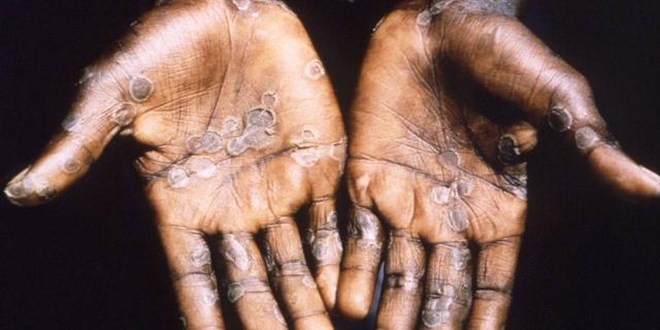 Maymun çiçeği virüsü nasıl ortaya çıktı?