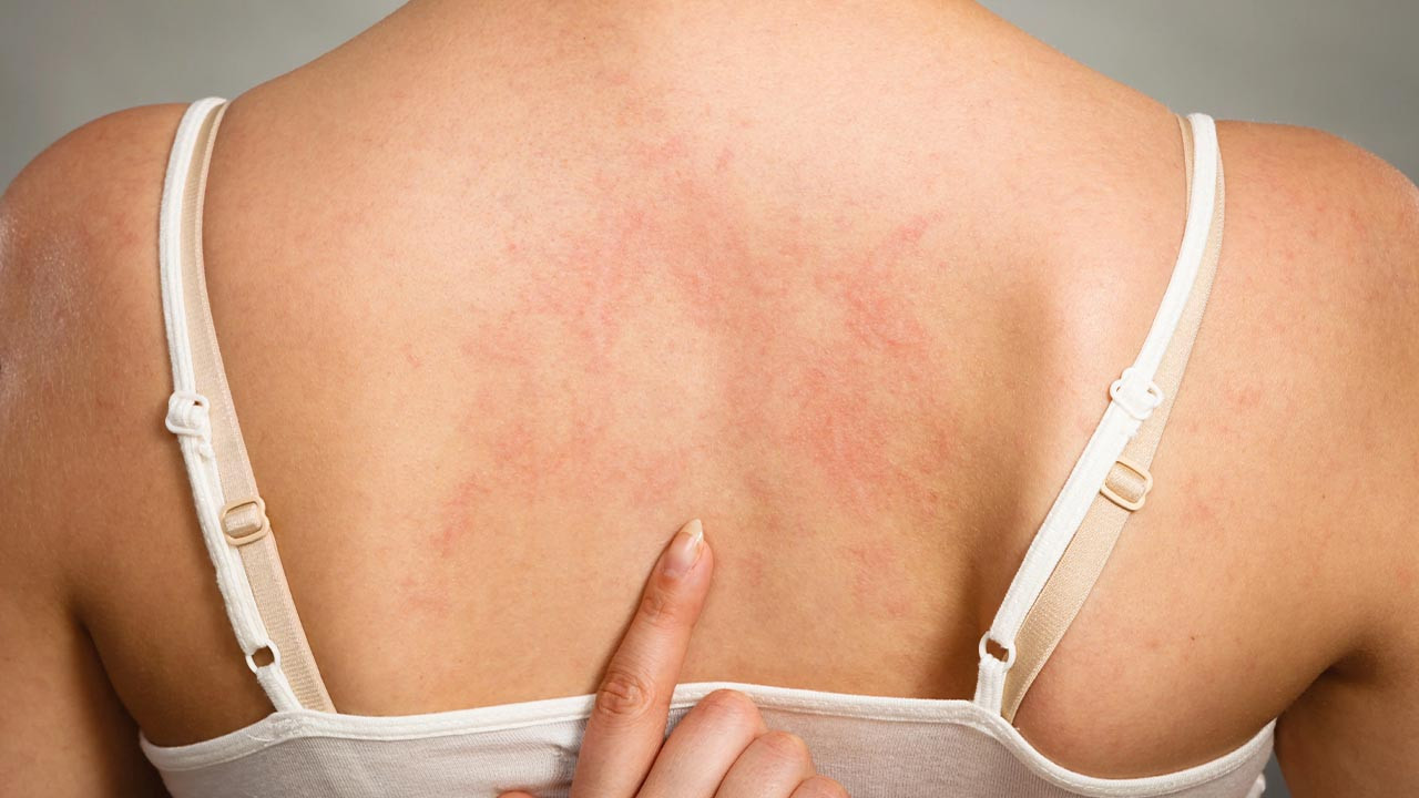 15 dakikada bulaşan uyuz hastalığı! Belirtileri 1.5 ay sonra ortaya çıkıyor!