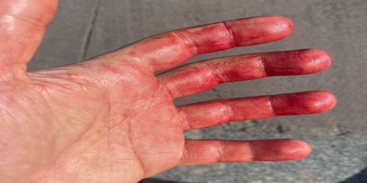 Maaşının yatırılmasını isteyen öğretmenin yüzüne sıcak su atıldı