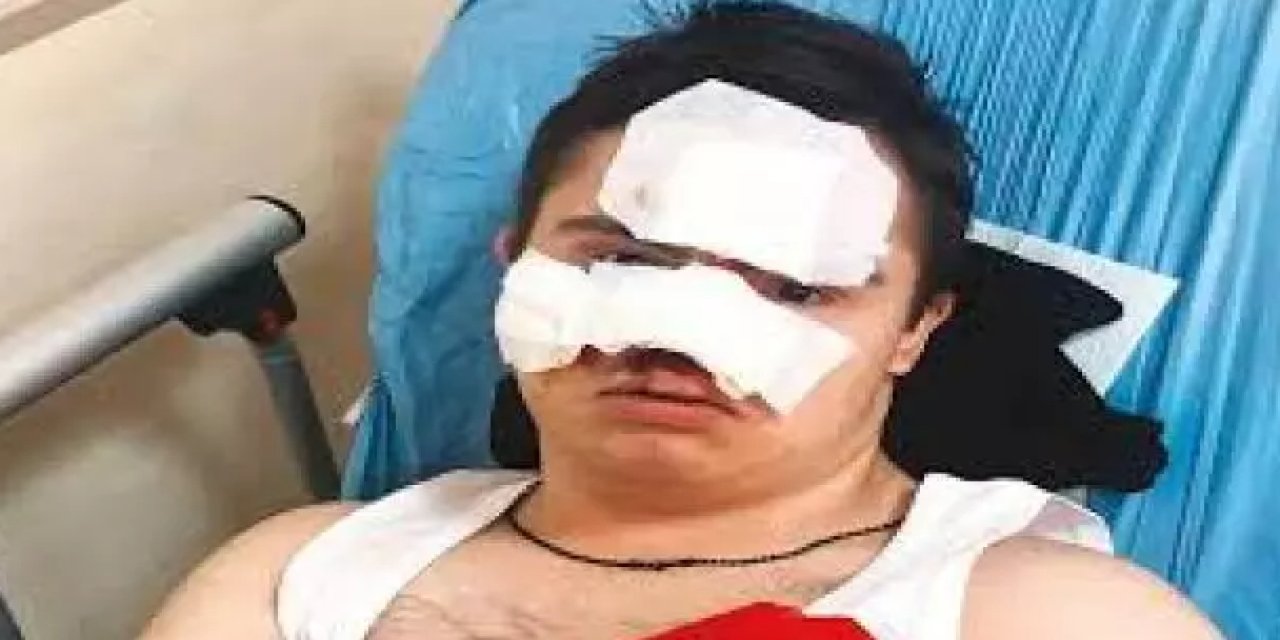 Down sendromlu çocuk okulda darbedildi iddiası!